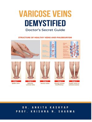 cover image of Varicose Veins Demystified